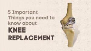 know about knee replacement