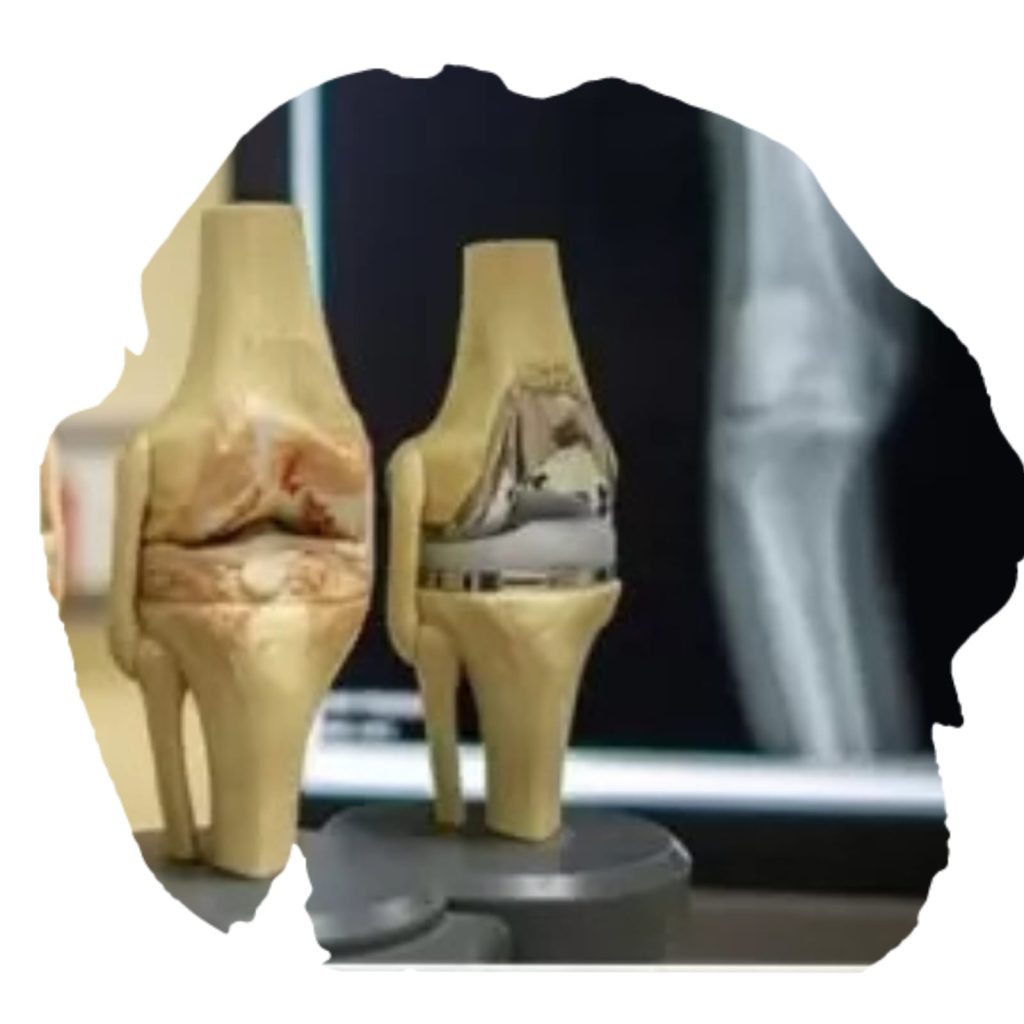 Knee Replacement